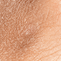 Dry skin