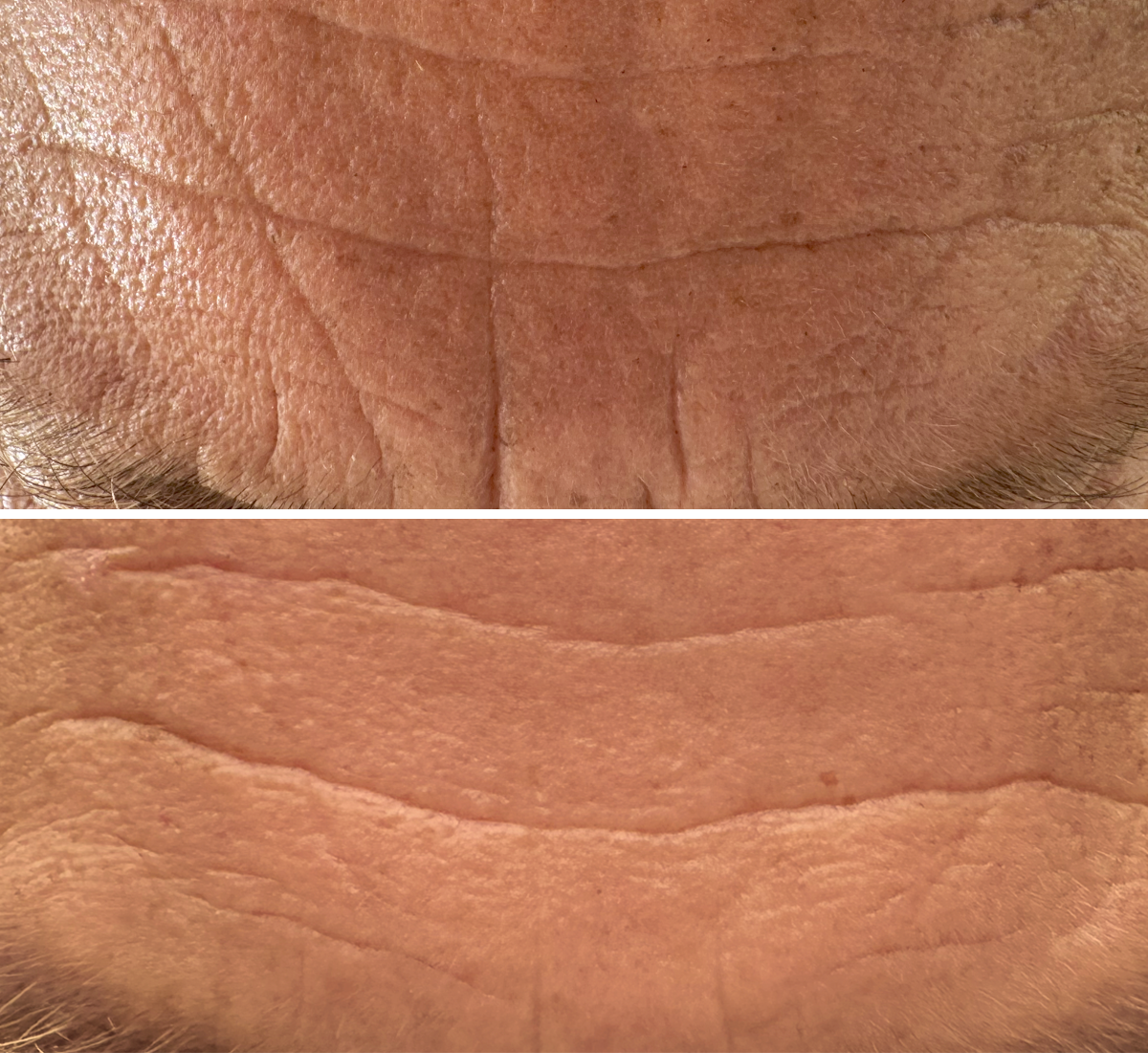 Advanced 4X Collagen Serum  Avant et après