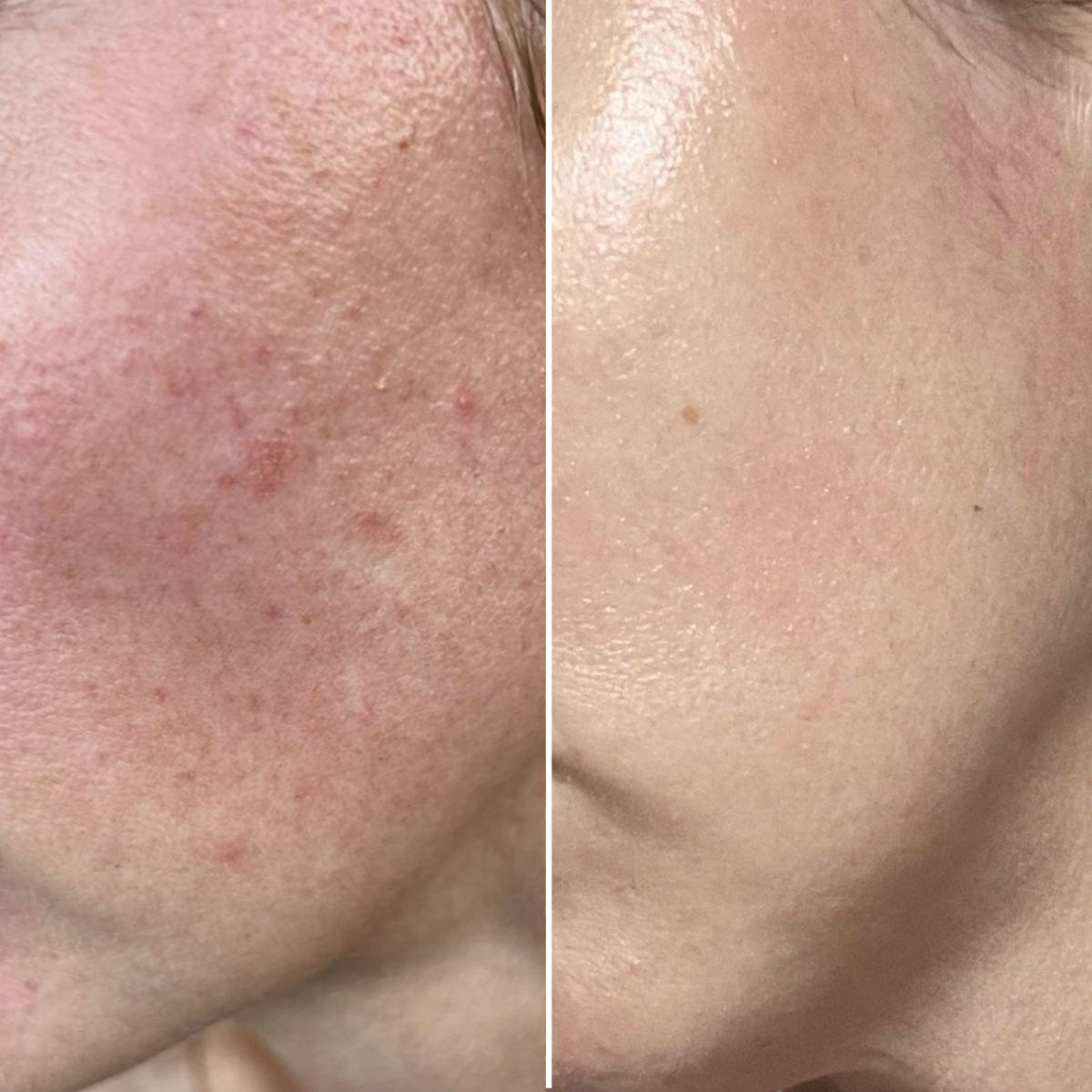 Barrier Recovery Cream CICA-C  Avant et après