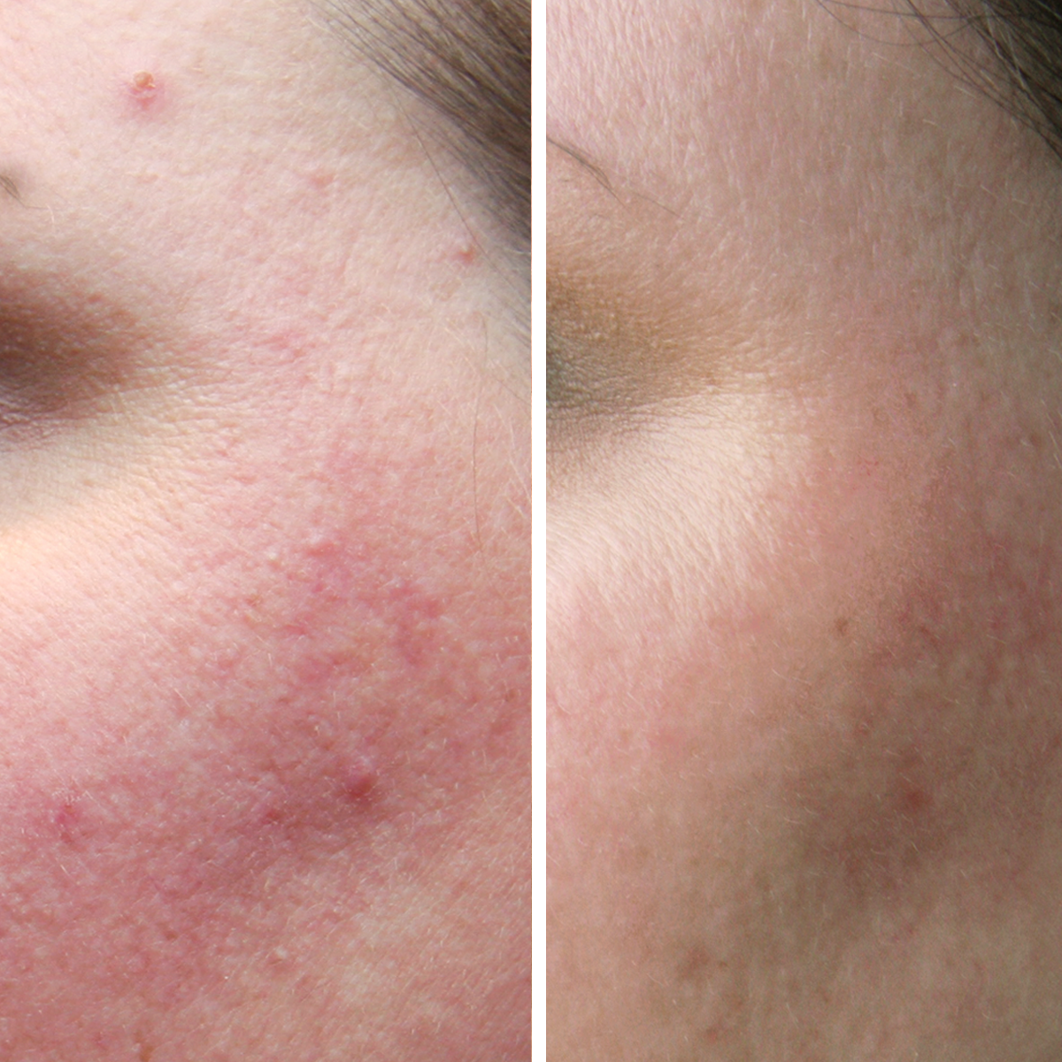 Clear Skin Cream + Zinc PCA - Before & After