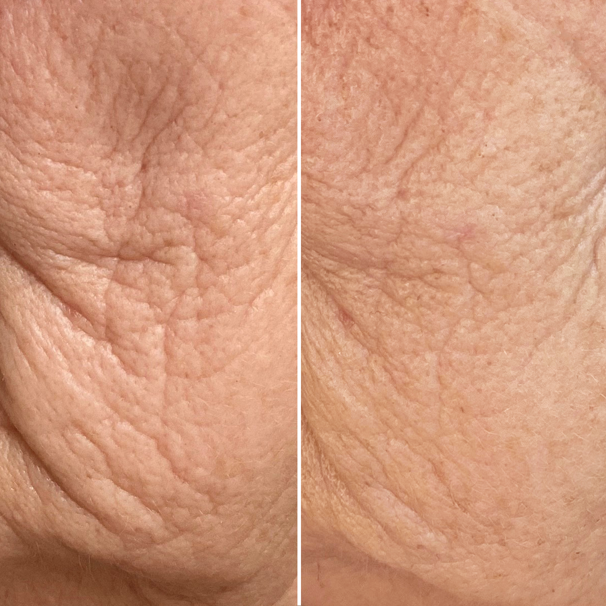 Lifting Peptides 8% Cream + HA  Voor & Na
