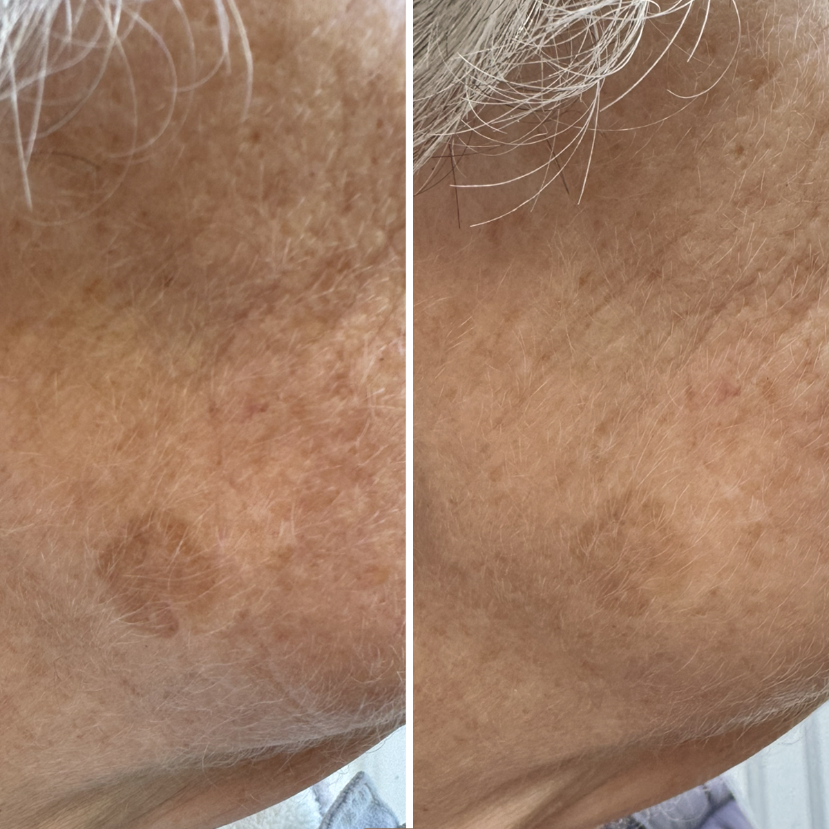 Resorcinol Glow Night Cream - Before & After