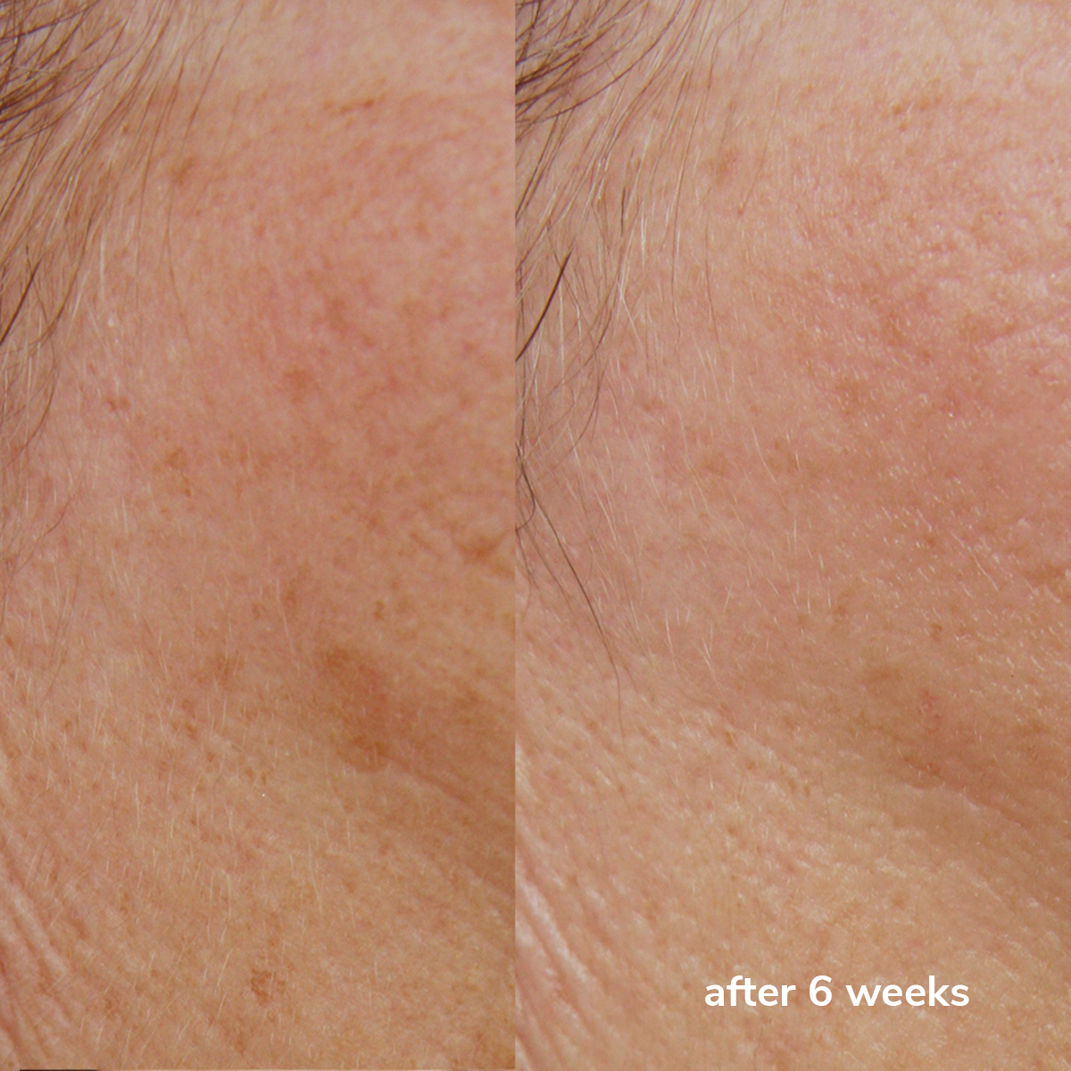 Melanin Corrector Serum + TXA  Vorher & Nachher