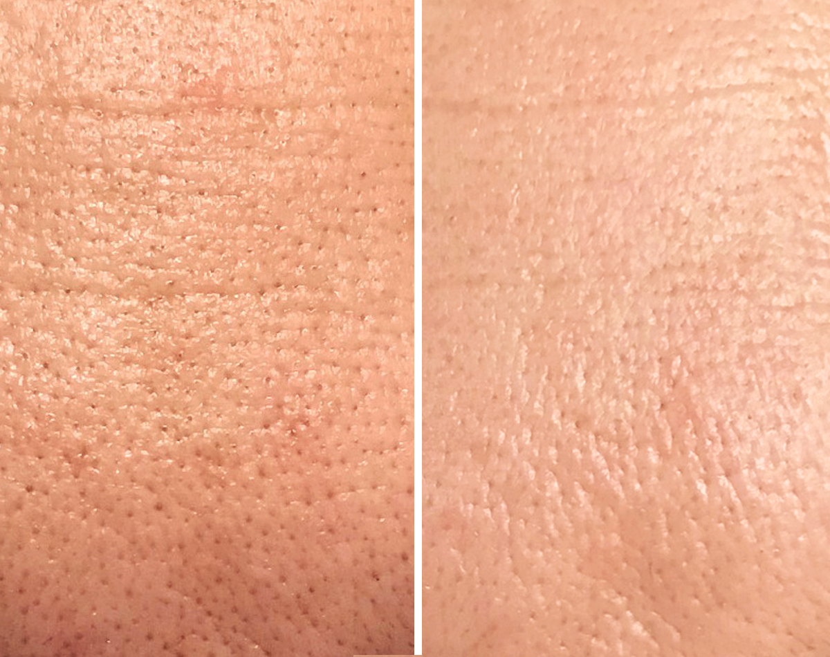 Night Peel AHA + PHA 18%  Voor & Na