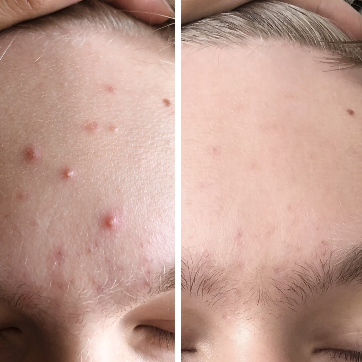 Salicylic Blemish Balm  Cadeau offert - Avant et après