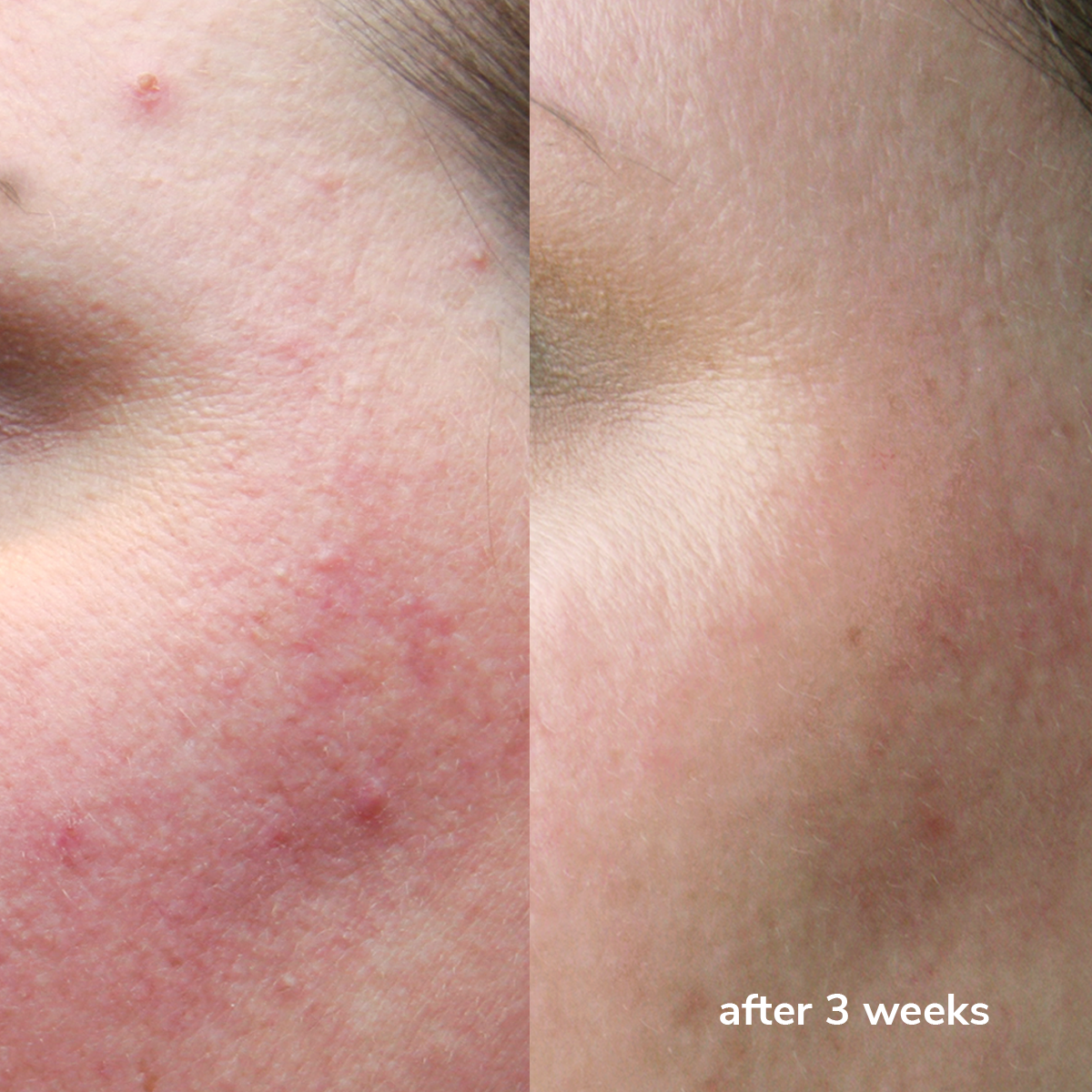 Clear Skin Cream + Zinc PCA  Vorher und Nachher