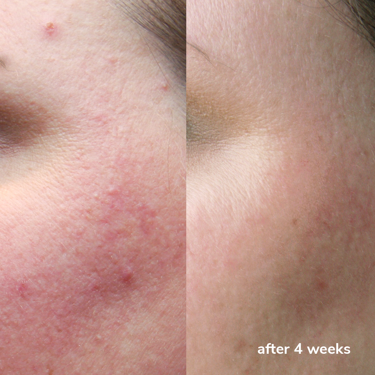 Clear Skin Cream + Zinc PCA