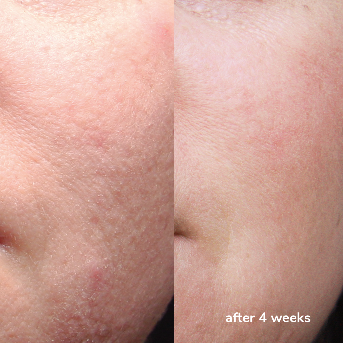 Hydration Serum PHA + PCA - Before & After