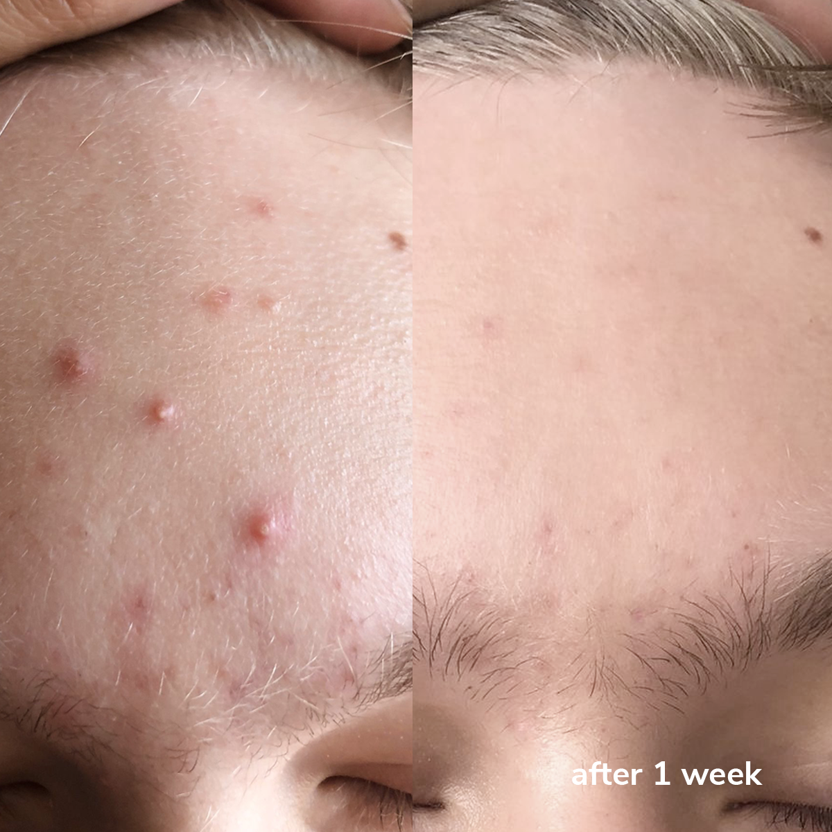 PHA Radiance Gel Cleanser - Before & After