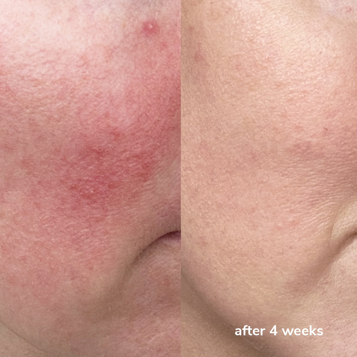 SignalNeedling Control Cream