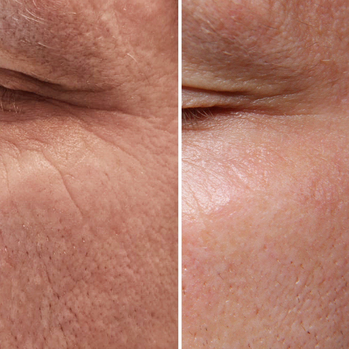 Eye Peptides 10% Cream - Before & After