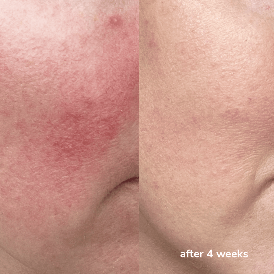 SignalNeedling Control Cream  Cleenlab.