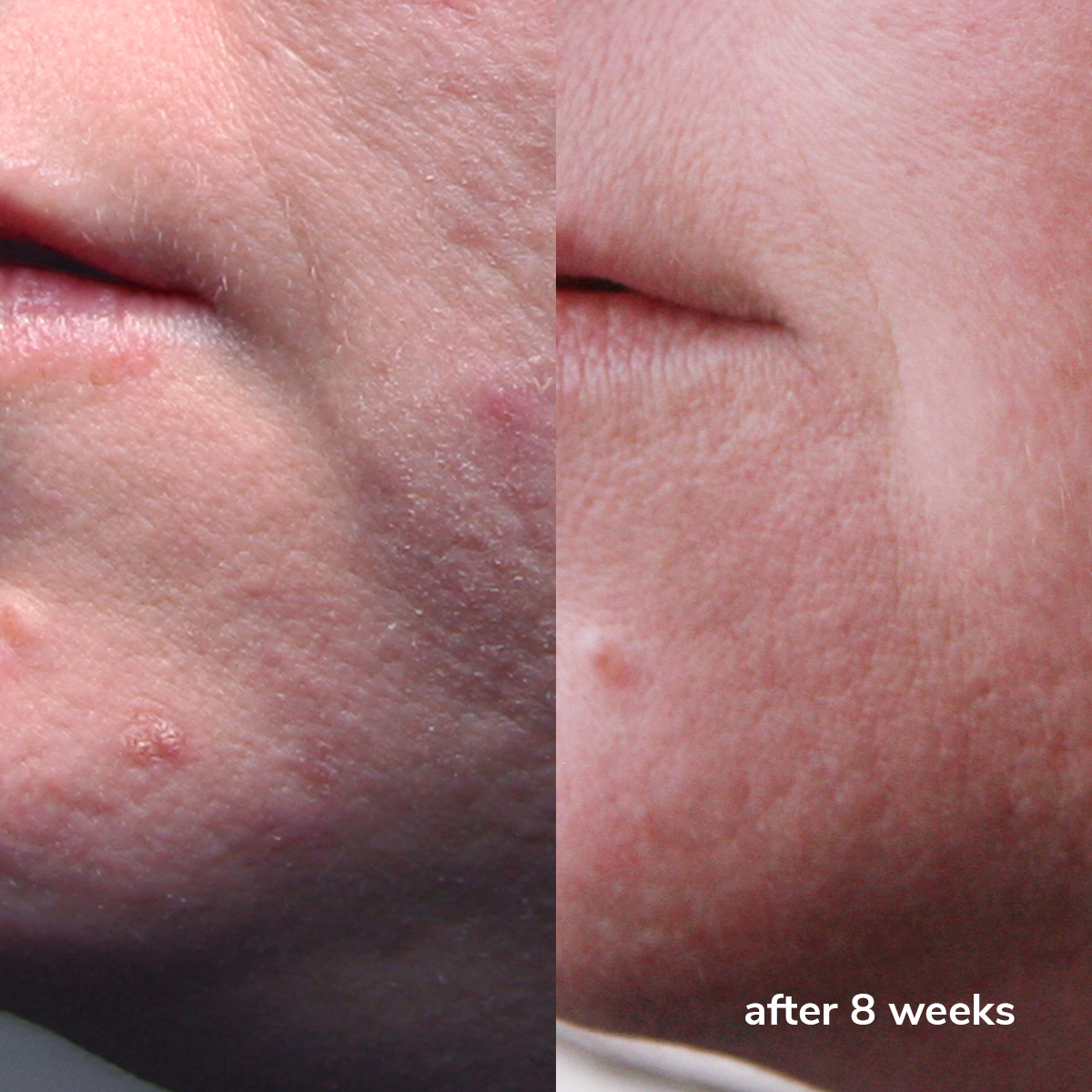 Clear Complexion Prep Essence - Before & After